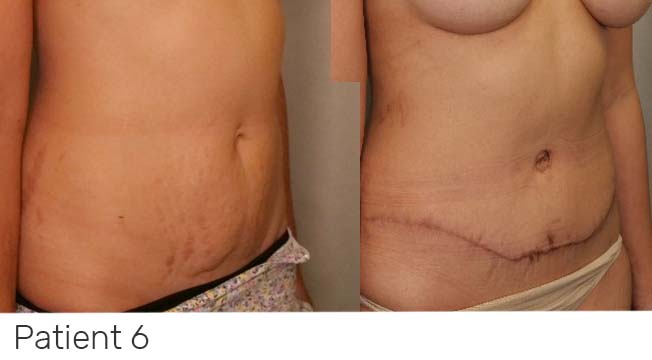 Tummy Tuck (Abdominoplasty) Brisbane - Dr Samuel Yang